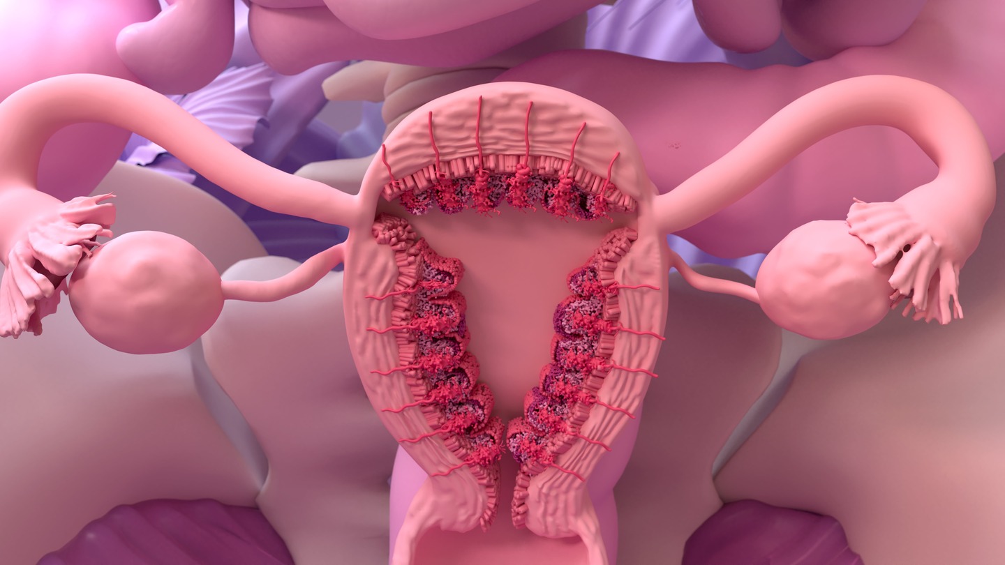 Adenomyosis depicted on the cross section of female anatomy.