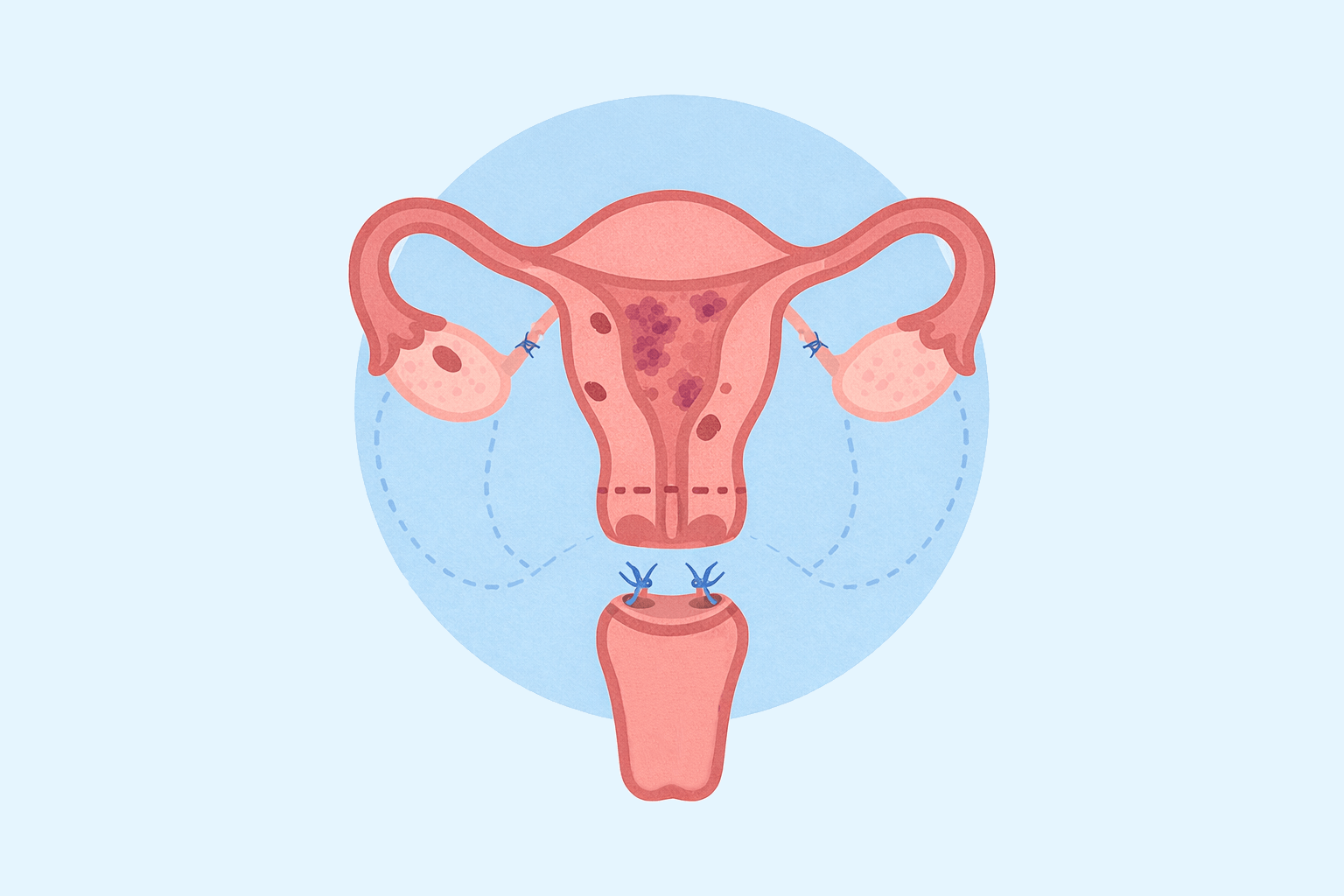 A flat illustration of a hysterectomy, depicting removal of the uterus, fallopian tubes, and ovaries.