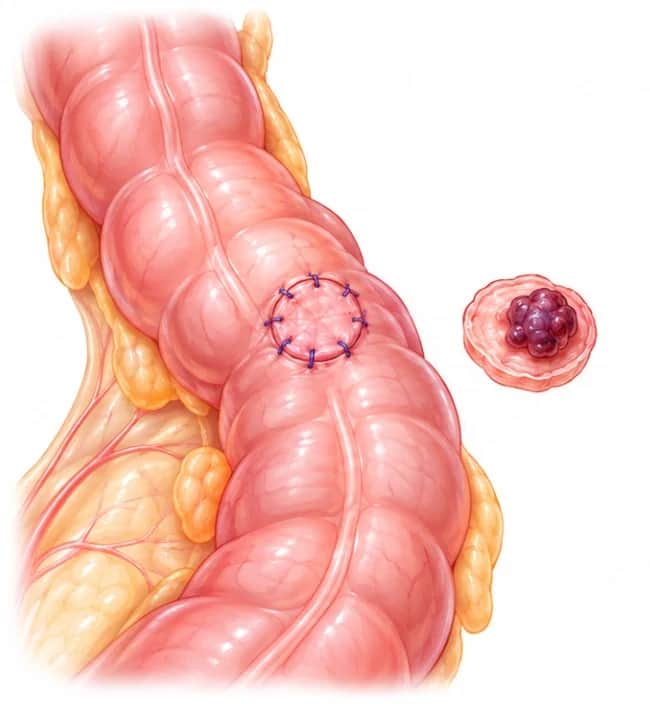 Disc excision: the bowel wall closed with a ring of stitches where a small disc was cut out, beside the removed disc with the nodule on it.