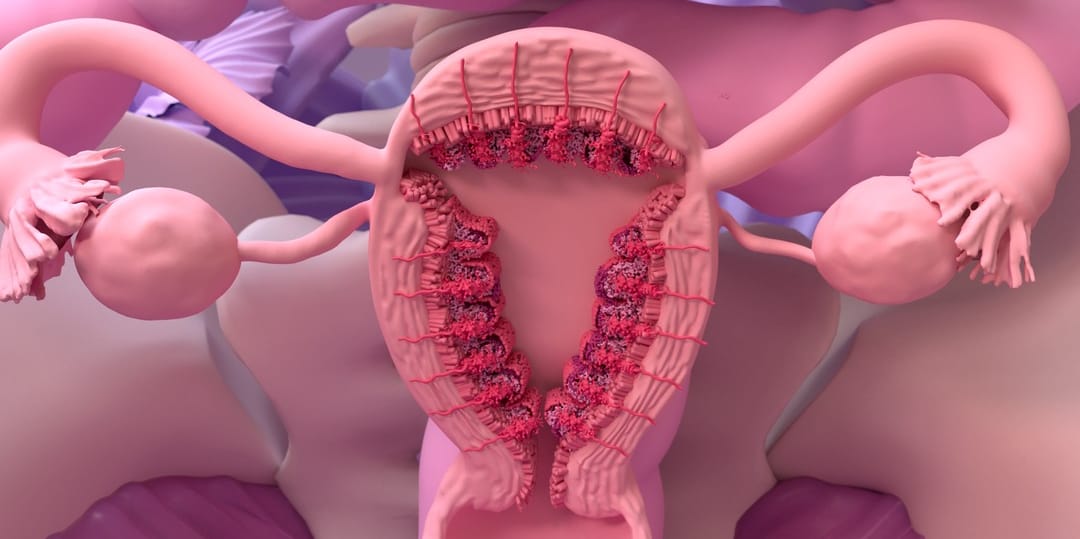 Adenomyosis depicted on a cross section of female anatomy.
