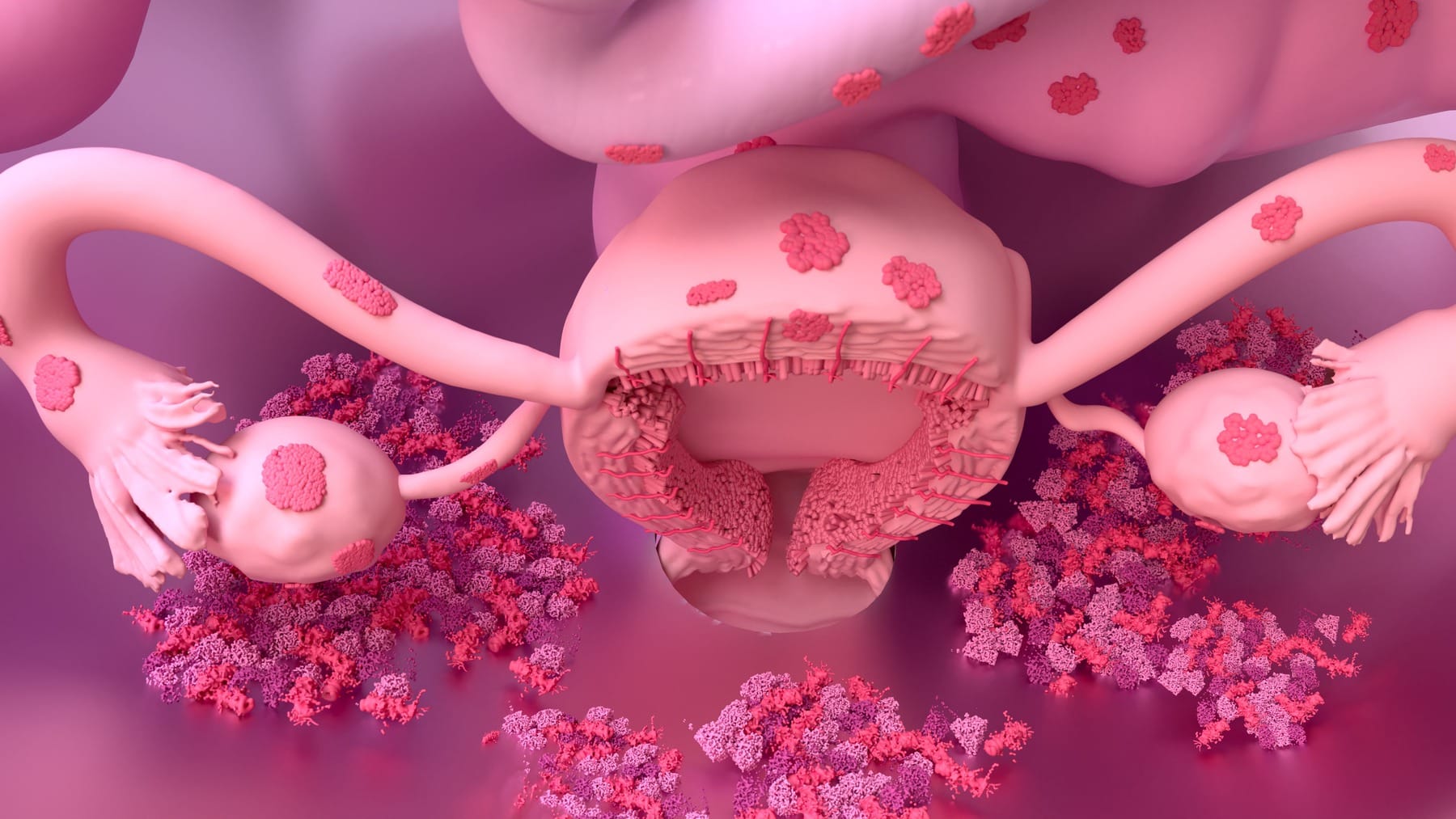 A top down depiction of endometriosis on female anatomy